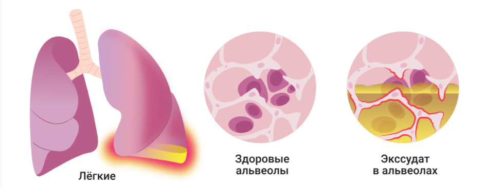 Экссудат.